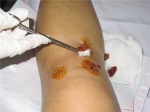 DỊCH VỤ RỬA VẾT THƯƠNG, THAY BĂNG CẮT CHỈ TẠI NHÀ